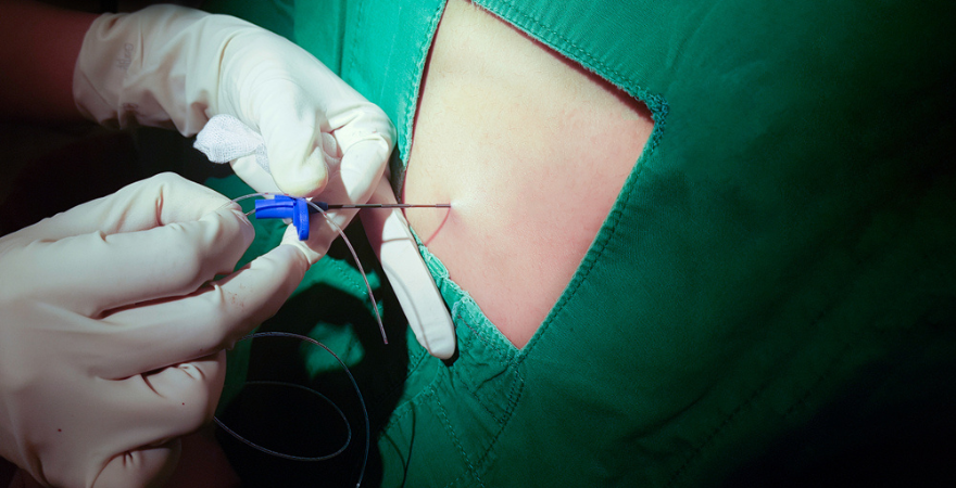 Precision Pain Relief: The Science and Future of Nerve Blocks