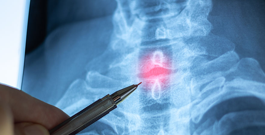 Why Neck Pain Often Appears Days After a Car Accident
